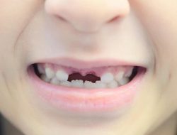 Bahaya Gigi Ompong Kerap Diabaikan Terlalu Lama, Bisa Picu Gangguan Serius